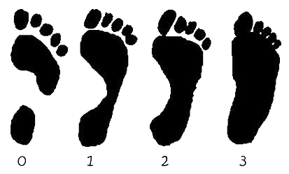 След ноги при различных степенях плоскостопия от нулевой до третьей