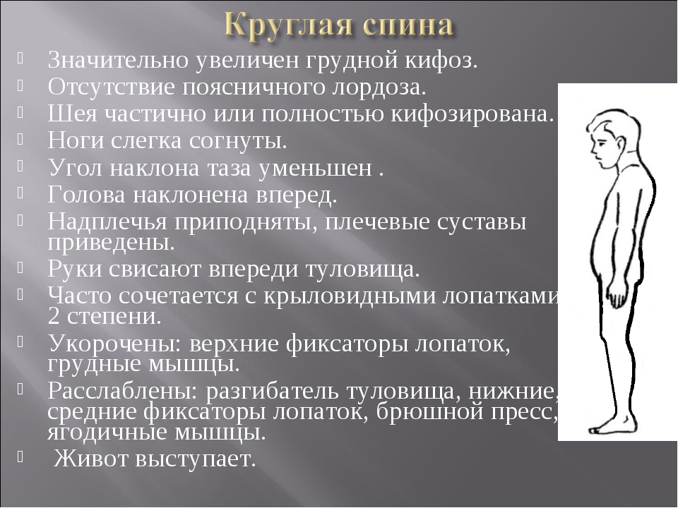 Грудной кифоз. Увеличенный грудной кифоз. Усиление грудного кифоза. Усиленный грудной кифоз.