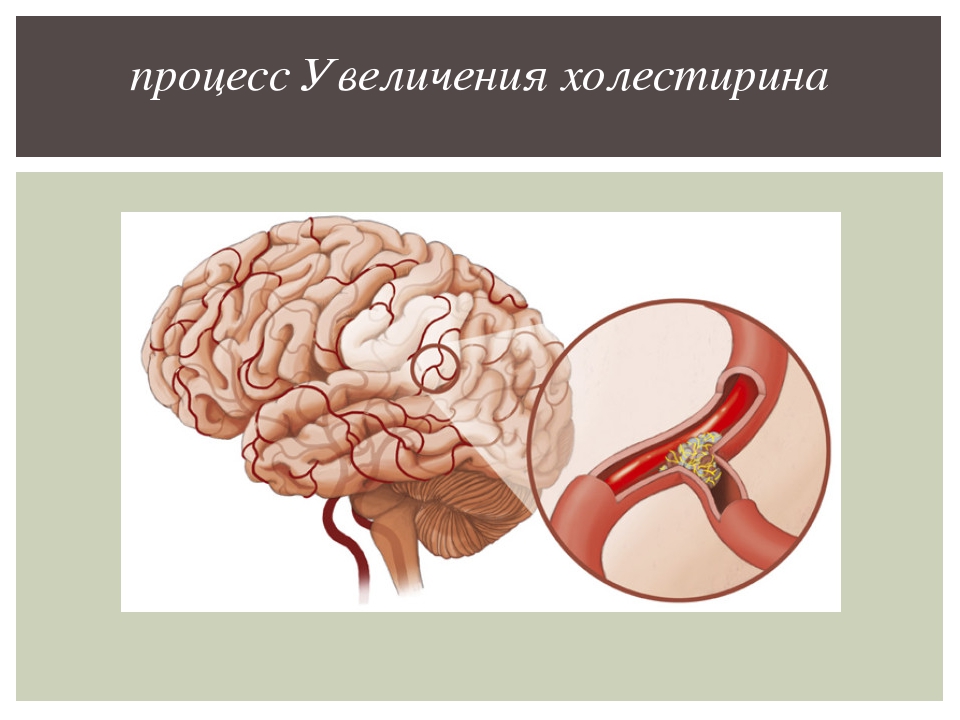 Нарушение кровообращения цнс. Церебральный атеросклероз ХСМН. Сосудистые заболевания головного мозга ОНМК. Очищение сосудов головного мозга. Патология головного мозга.