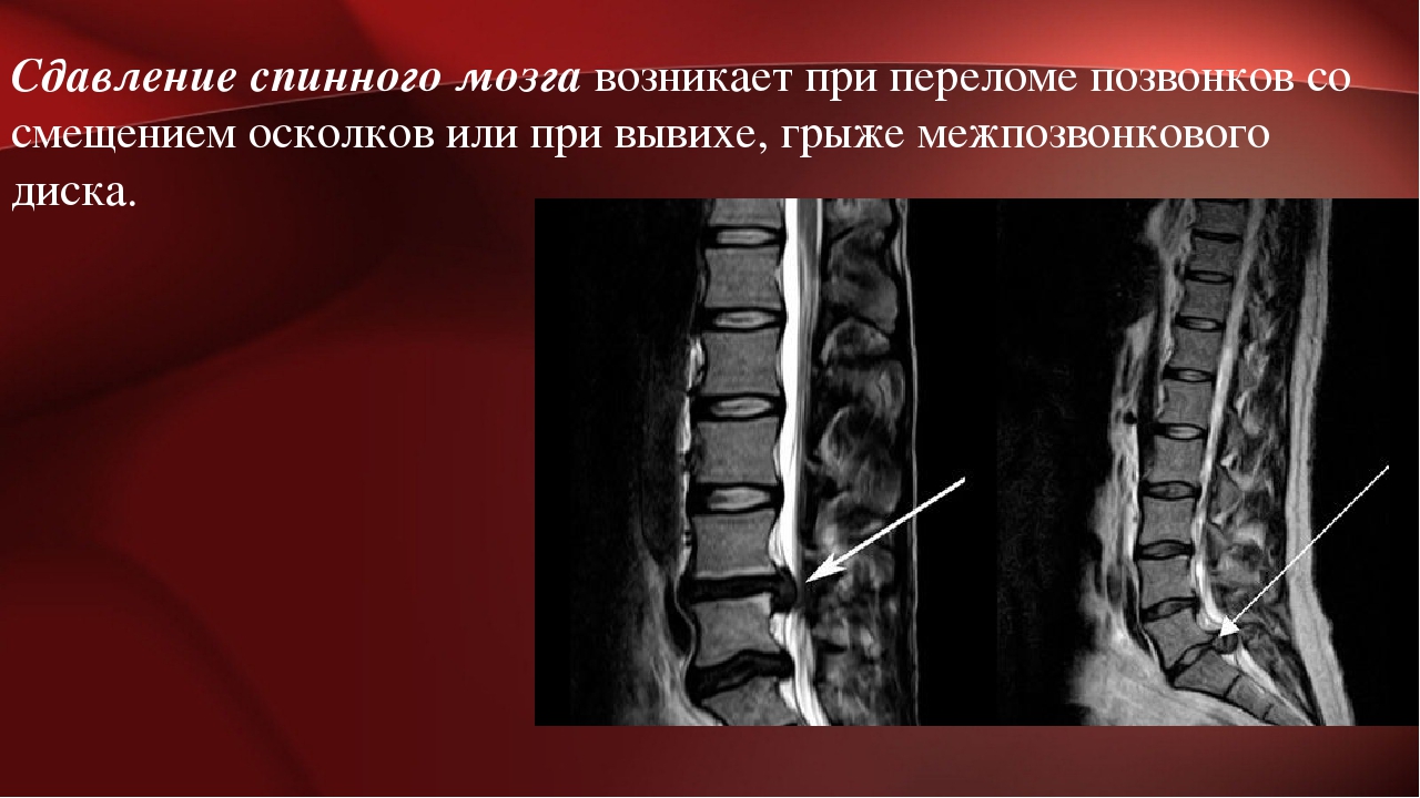 Последствие перелома позвоночника мкб. Миелопатия спинного мозга мрт. Повреждение спинного мозга в поясничном отделе. Миелопатия шейного отдела позвоночника мрт. Травма поясничного отдела спинного мозга.