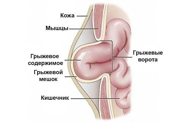 Заговор от грыжи паховая читать