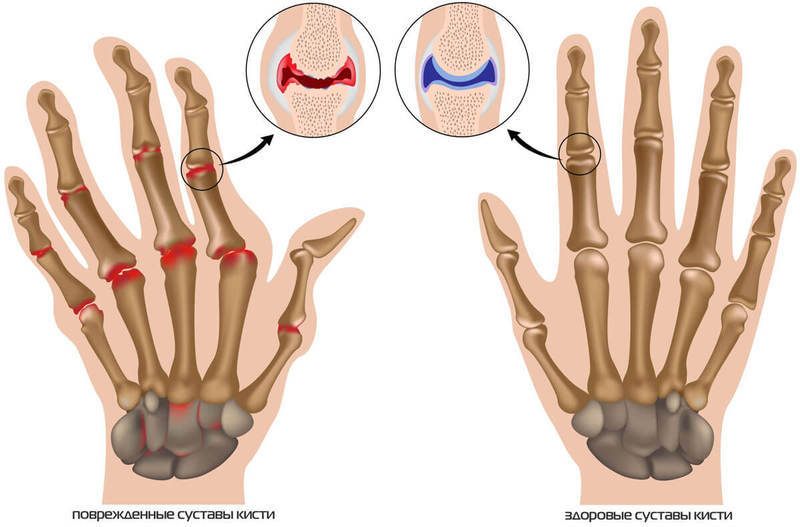 Лечение артроза пальцев рук