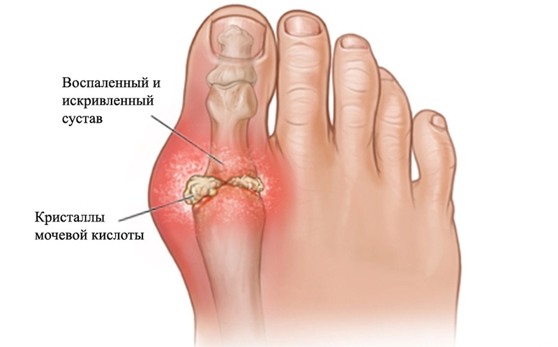 Подагра: болезнь, связанная с образом жизни