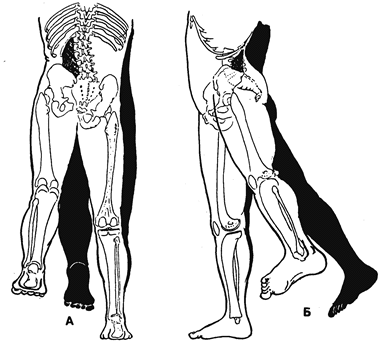 Синдром квадратной мышцы поясницы