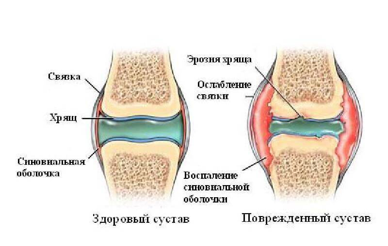 Почему хрустят суставы