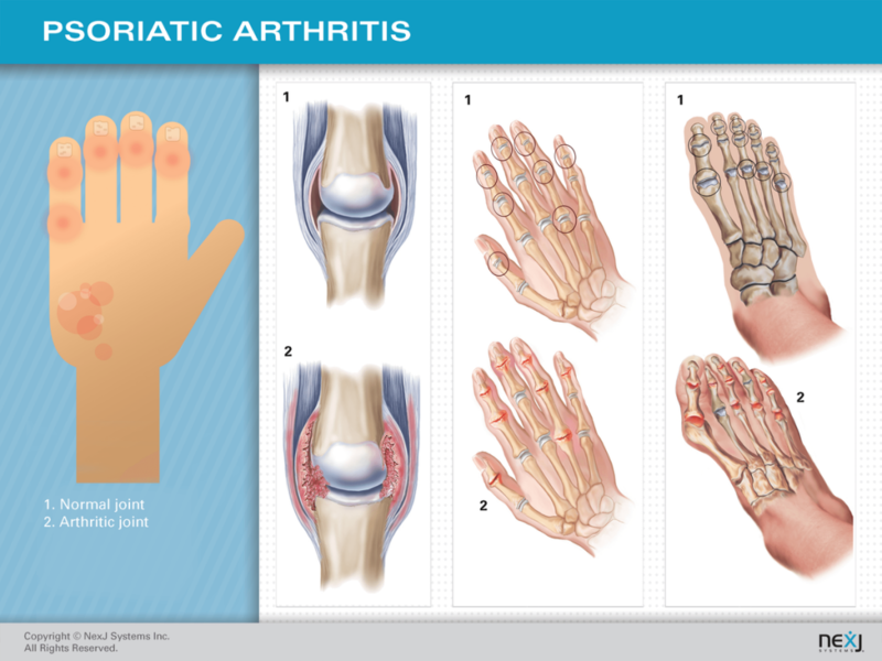 Псориатический артрит: 5 основных типов