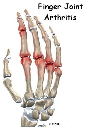 Finger Joint Arthritis