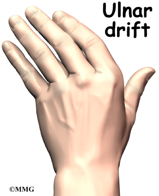 Finger Joint Arthritis