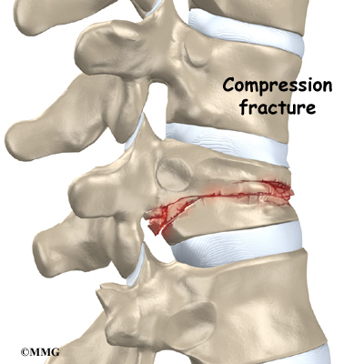 Spinal Compression Fractures