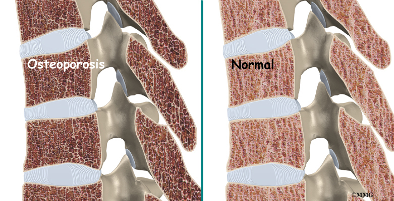 Spinal Compression Fractures