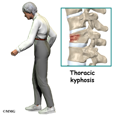 Spinal Compression Fractures