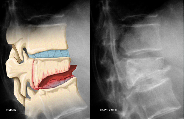 Spinal Compression Fractures