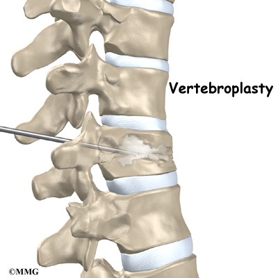 Spinal Compression Fractures