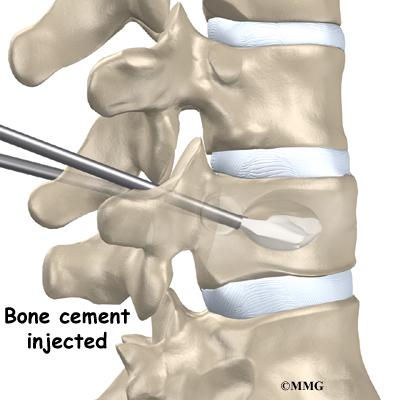 Spinal Compression Fractures