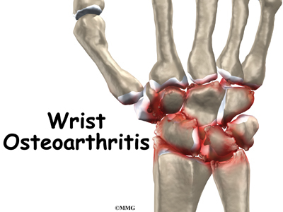 Wrist Joint Osteoarthritis