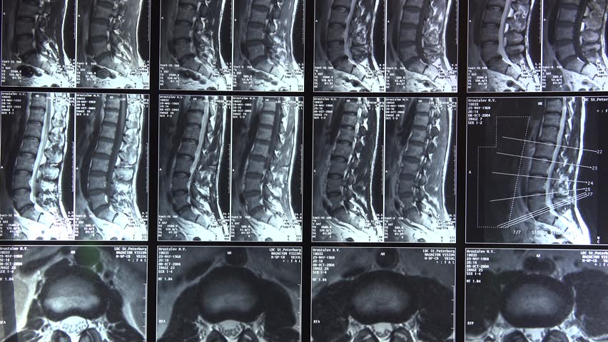 Компьютерная томография позволяет визуализировать позвоночник
