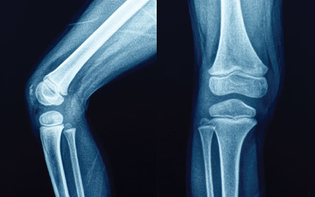 Рентгенография - важный метод диагностики ревматизма суставов