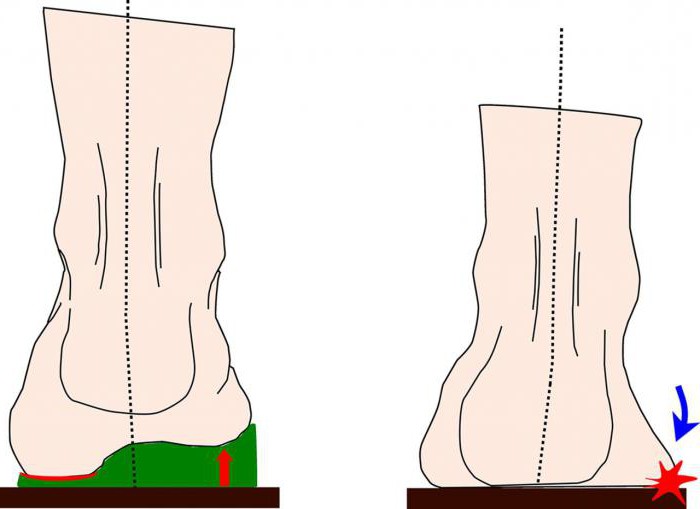 Ортопедическая обувь для детей при вальгусной установке стоп для детей