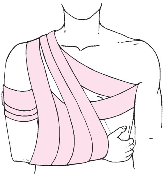 фиксирующая повязка на плечевой сустав