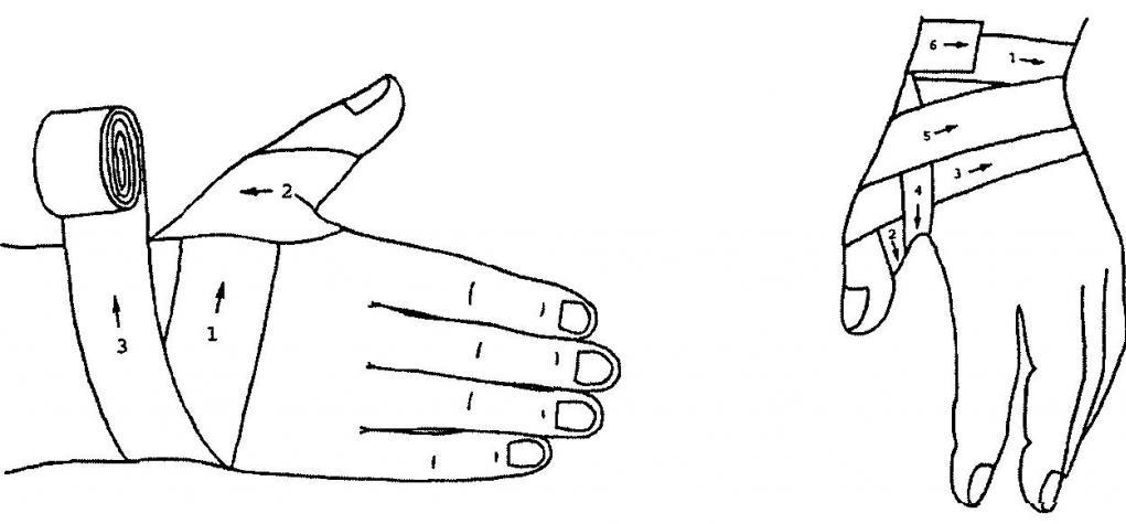колосовидная повязка на большой палец