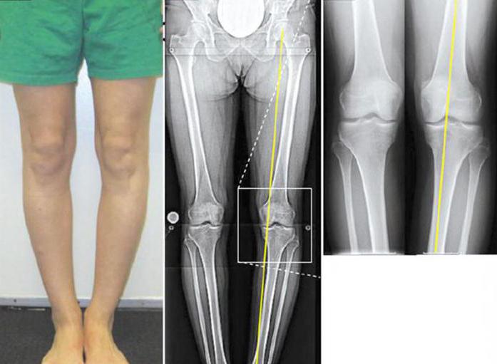 вальгусная деформация коленных суставов у детей лечение