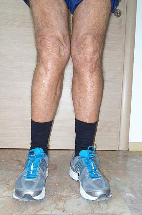 вальгусная деформация коленного сустава лечение