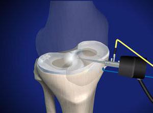 операция по удалению мениска коленного сустава 