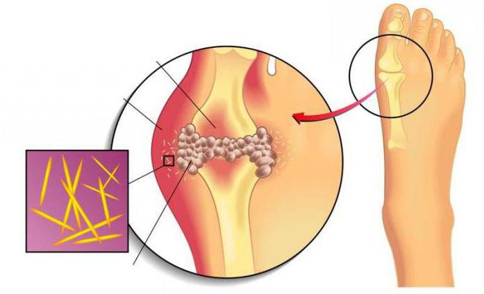лечение подагры при обострении