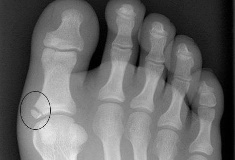 перелом большого пальца ноги нужен ли гипс 