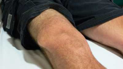 деформирующий артроз коленного сустава причины
