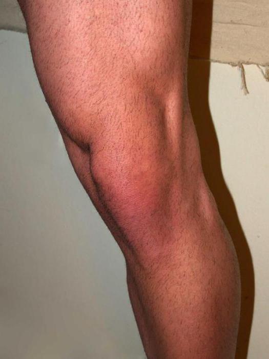 разрыв мениска коленного сустава лечение без операции