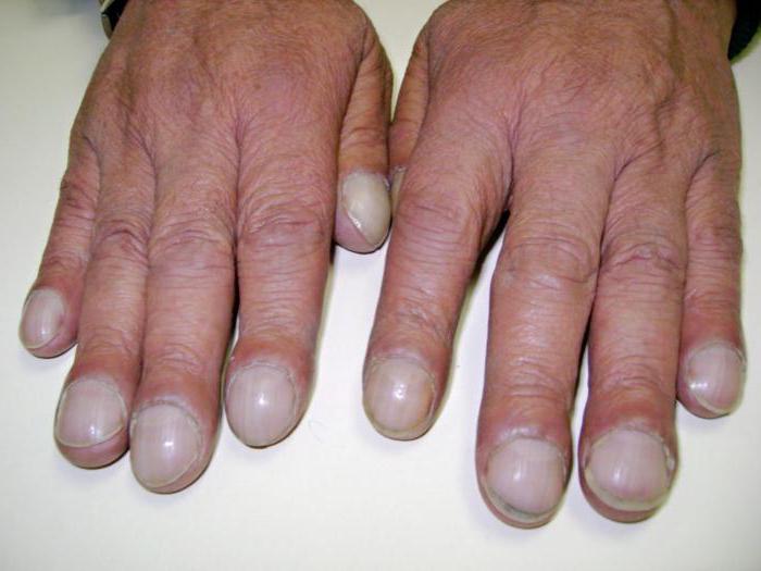 диагностика болезней по ногтям рук