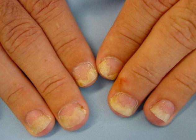 диагностика по ногтям на руках