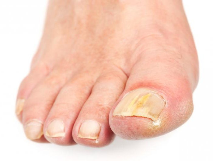 диагностика по ногтям пальцев ног