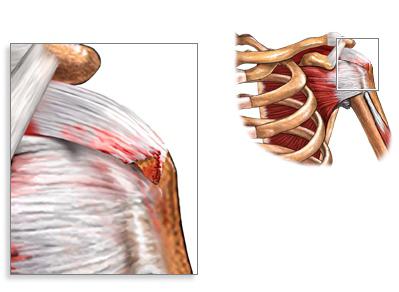 разрыв связок плечевого сустава симптомы