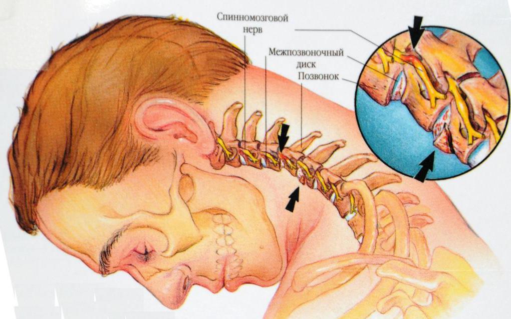 шейный остеохондроз симптомы лечение в домашних условиях