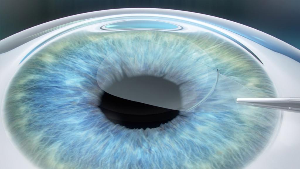 лазерное лечение сетчатки глаза