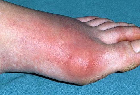 Заболевание пальцев ног