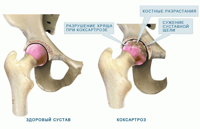 коксартроз тазобедренного сустава симптомы и лечение