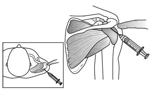 пункция плечевого сустава техника выполнения 
