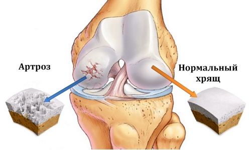 Артроз и нормальный хрящ