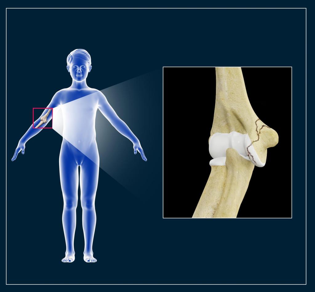 перелом лучевой кости ребенка