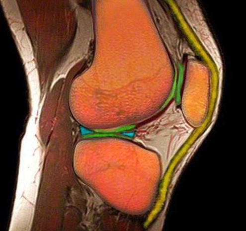 разрыв мениска коленного сустава симптомы