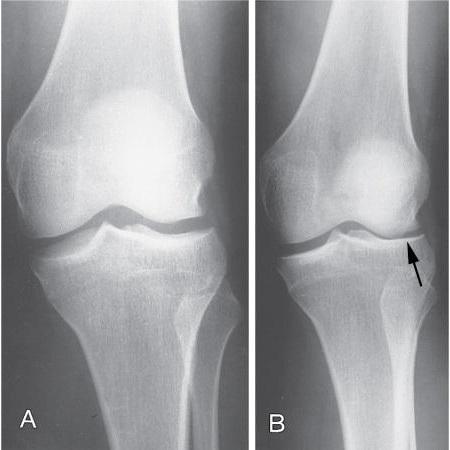 болезнь шляттера коленного сустава у подростка лечение 