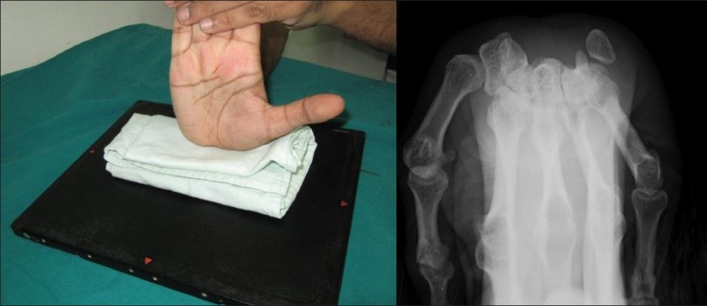 рентген снимки лучезапястного сустава