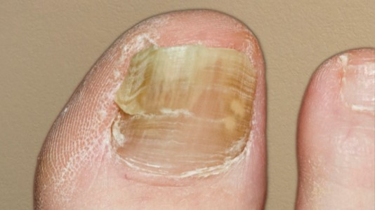 почему ногти отходят от кожи