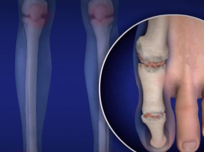 Болезни суставов ног стопы лечение