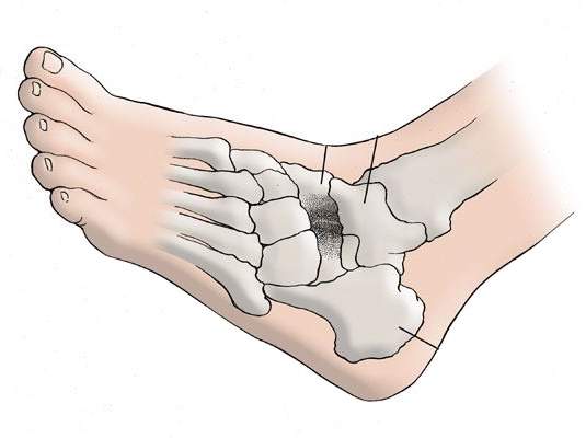 Лечение артрита ног
