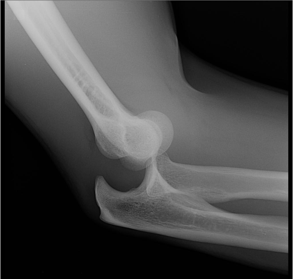 Фото вывиха локтевого сустава (рентген), вид сбоку