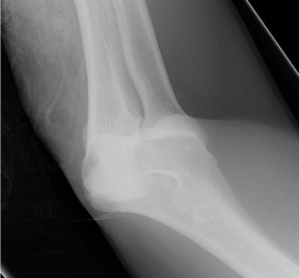 Фото вывиха локтевого сустава (рентген), вид спереди